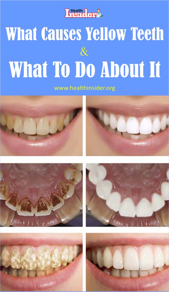 Yellow Teeth Causes