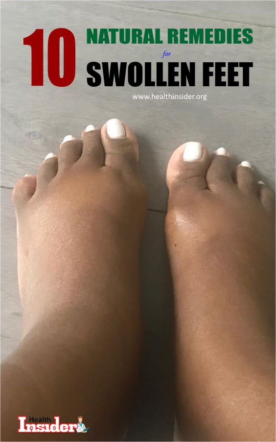 Do you constantly experience the agony of swollen ankles and feet? Here are 10 natural remedies to reduce swelling in the feet. #swollenfeetremedies
