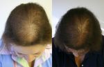 Hair Loss Diet Female