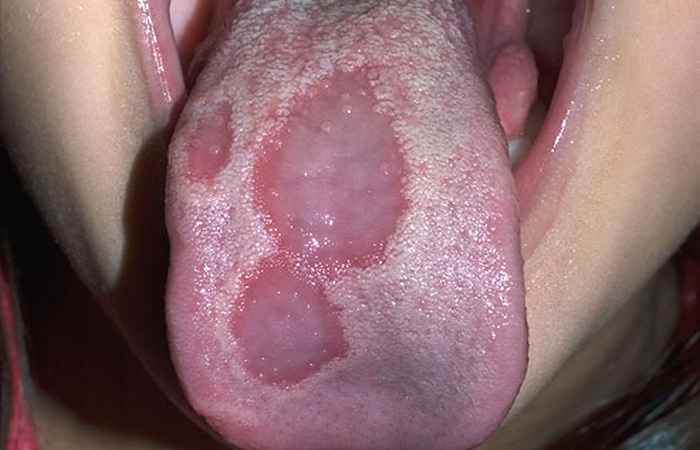 Geographic Tongue Mouth Problem