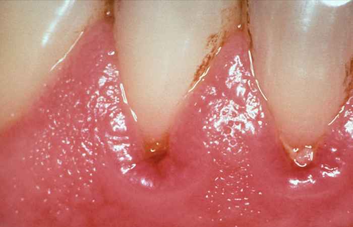 Gum Disease Mouth Problem