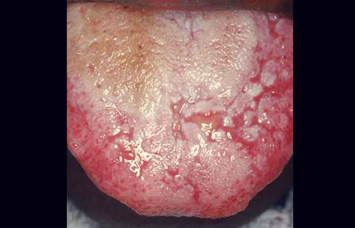 Lichen Planus Mouth Problem